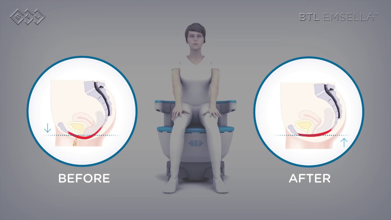 diagram displaying the before and after effects of emsella on the body.